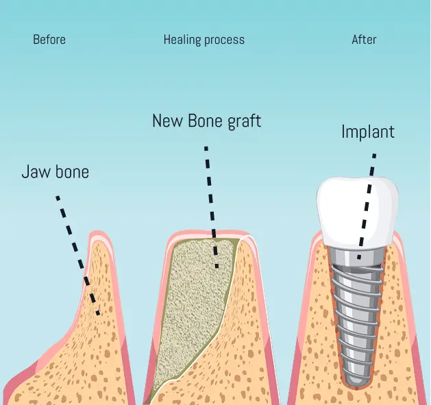 TourDent bone grafting diagram showing jawbone, new bone graft and dental implant placement stages