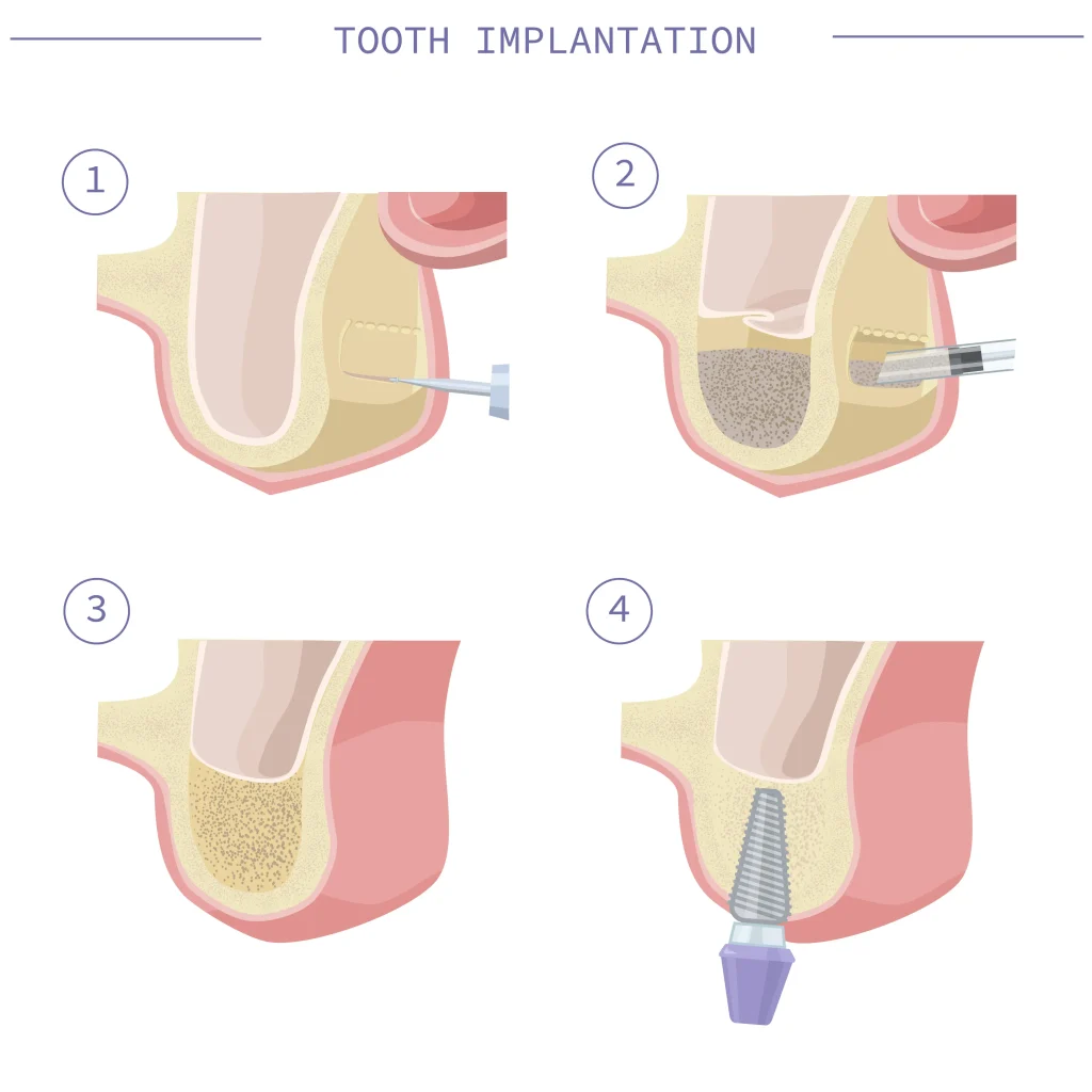 TourDent tooth implantation 4-step diagram showing anesthesia, bone preparation, grafting and implant placement