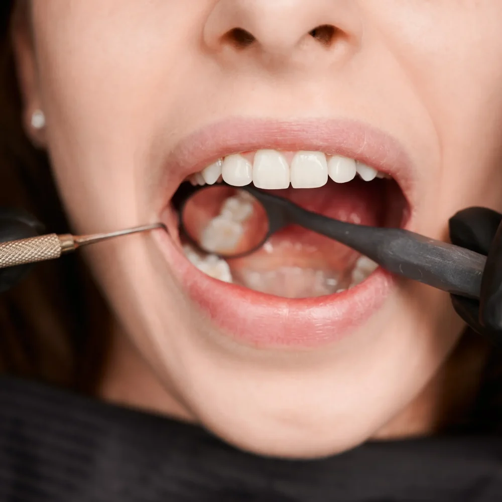 TourDent close-up dental examination with mirror and probe checking patient teeth and fillings