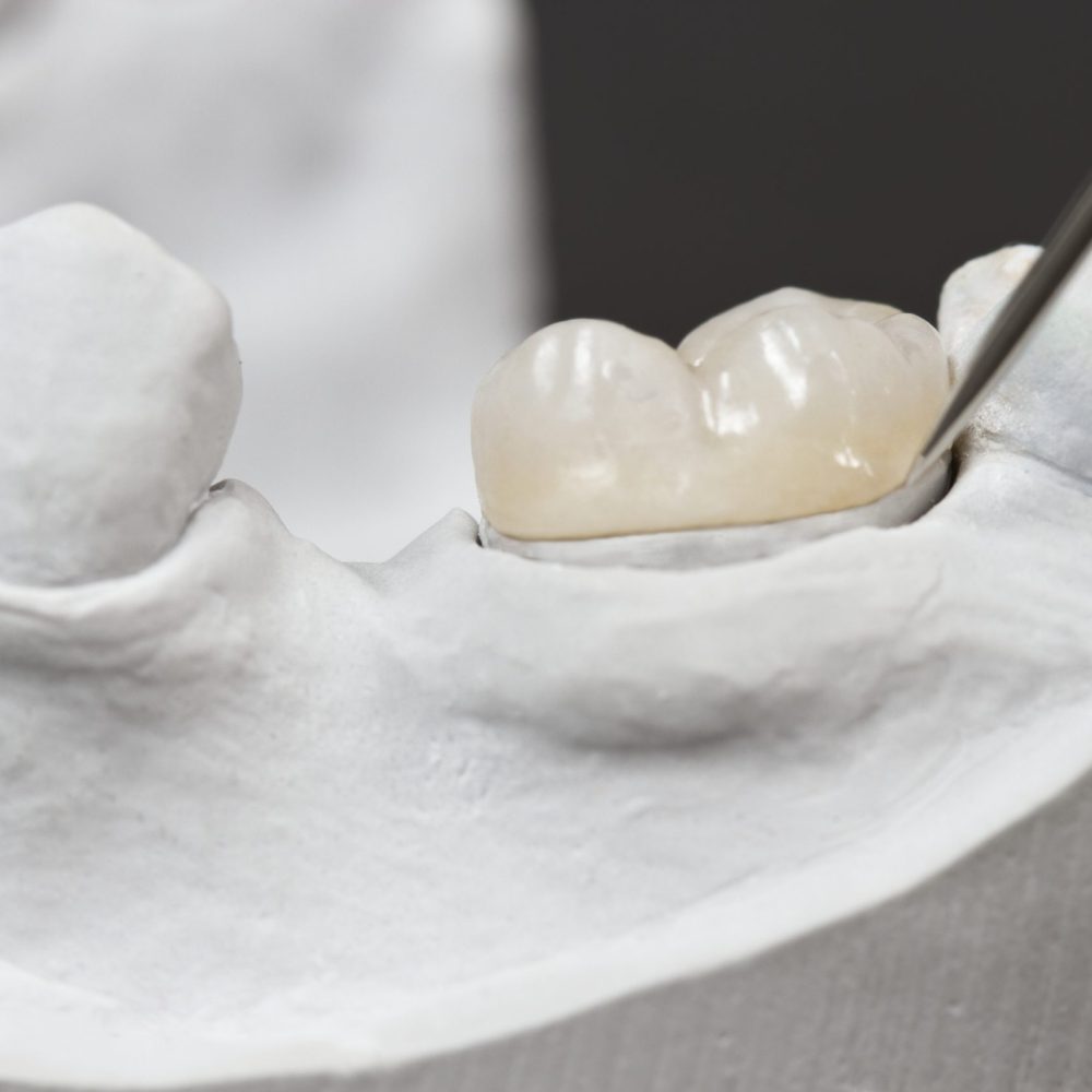 TourDent ceramic dental onlay placed on cast model with dental instrument — precision prosthodontics