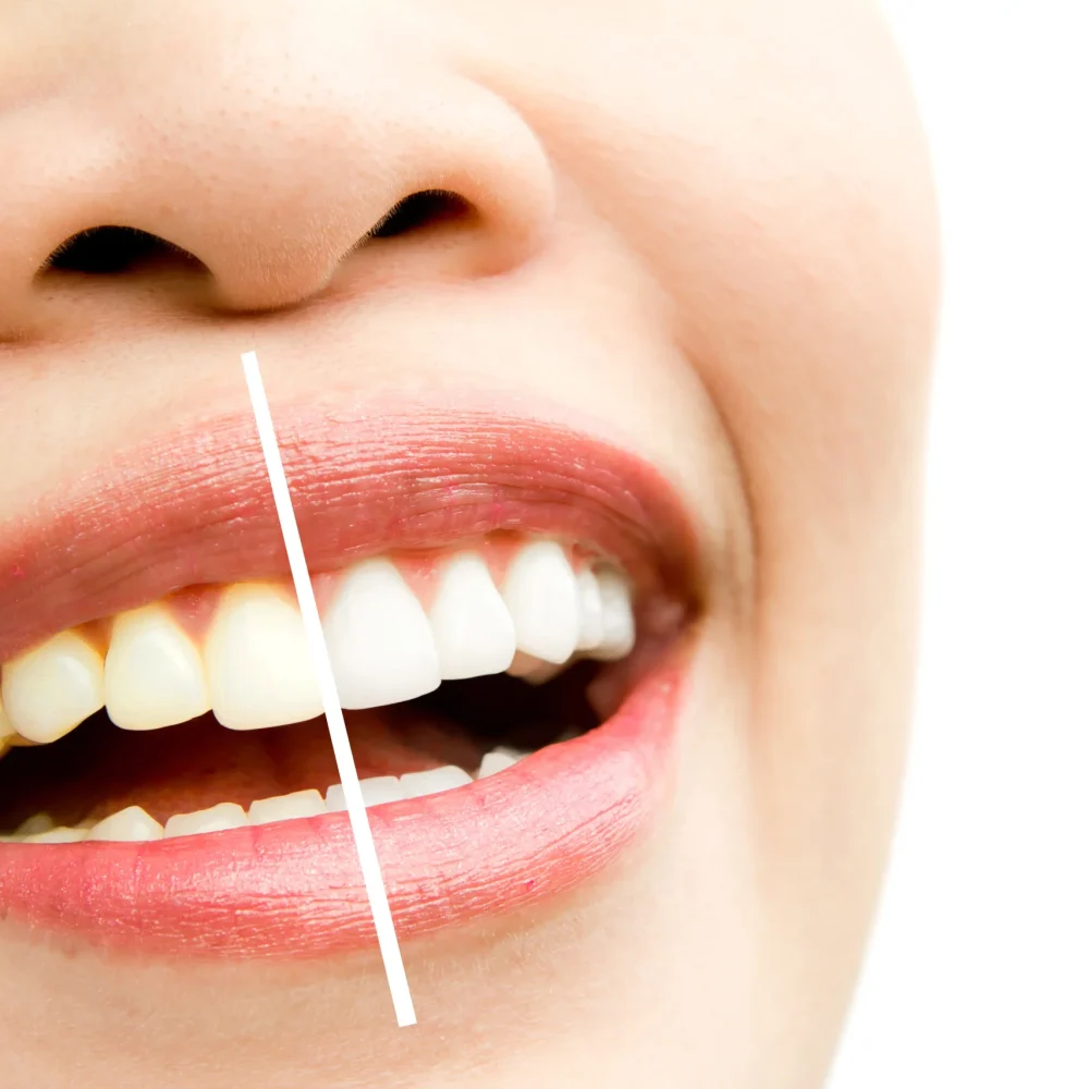 TourDent teeth whitening before and after close-up showing yellow teeth transformed to bright white smile
