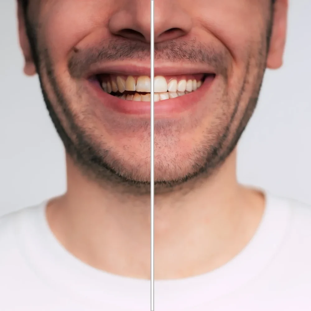 TourDent teeth whitening before and after results on man showing stained teeth transformed to bright white smile