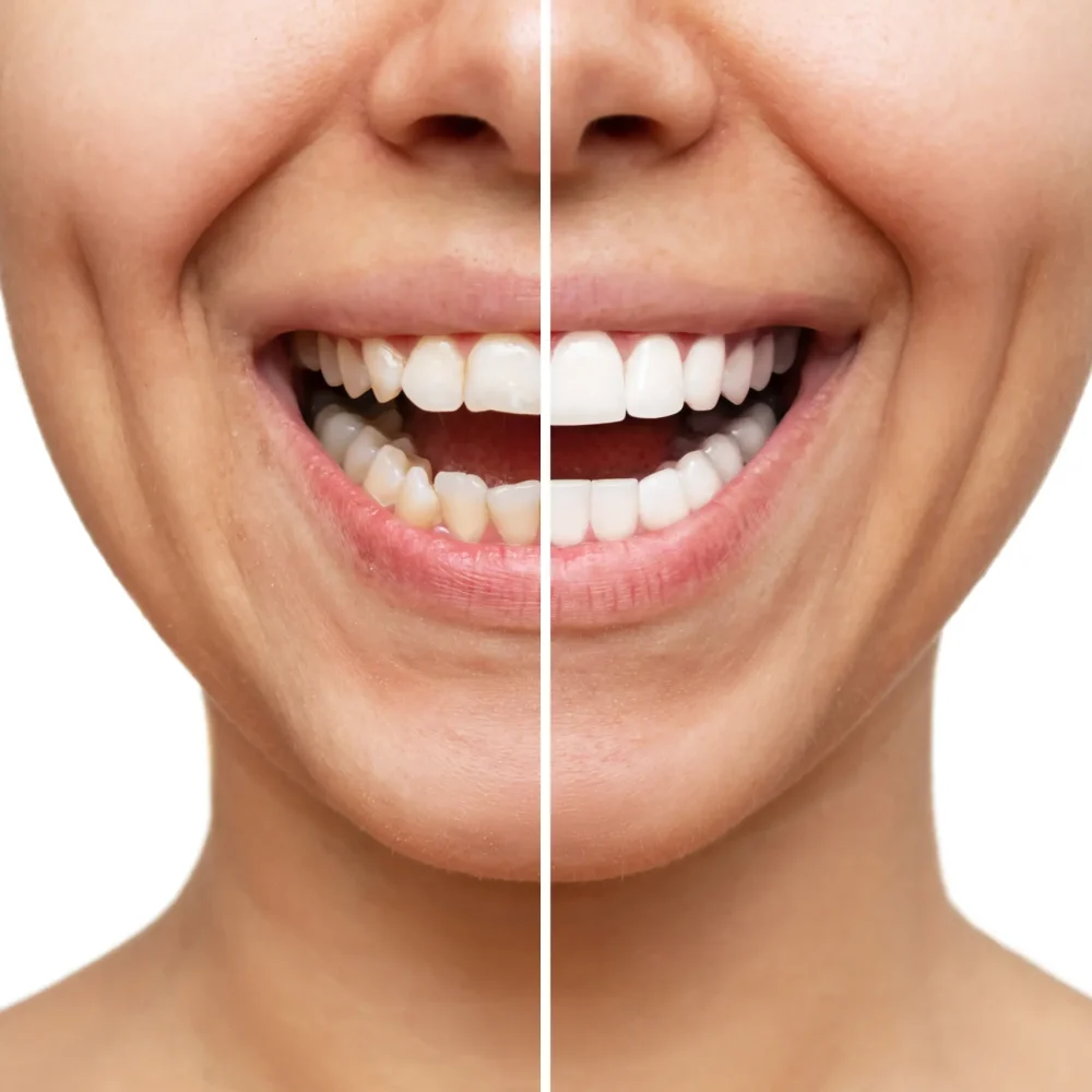 TourDent close-up portrait of woman with perfect white smile after dental treatment